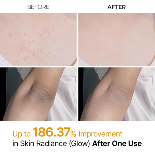 Norré Body Peel+